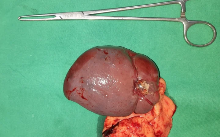 Dieta bogată în fitochimicale reduce cu 31% riscul de cancer ovarian, arată un nou studiu
